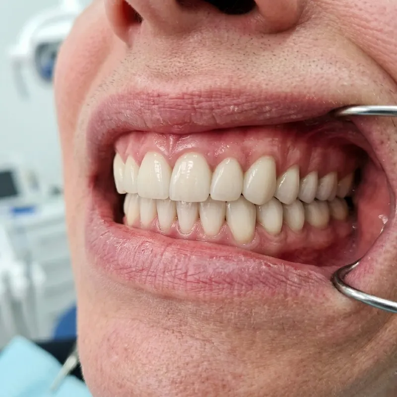 Real patient after All-on-4 dental implants at DHA Phase 5 clinic showing a perfectly restored smile